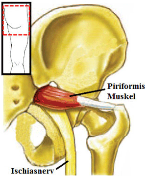 Schematische Darstellung der anatomischen Beziehung zwischen den Ischiasnerv und Piriformis muskeln