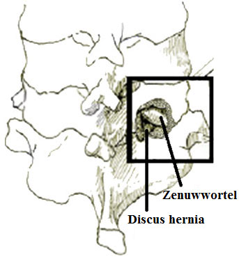 Tentoonstelling cervicale hernia
