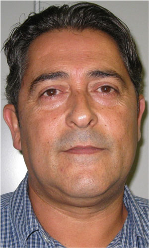 Dolor lumbar crónico