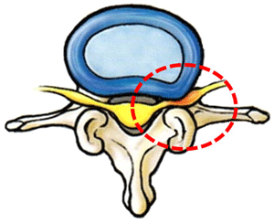 Protrusión discal lumbar con compresión radicular 