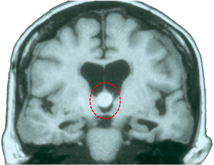 Colloid cyst as a cause of obstructive hydrocephalus