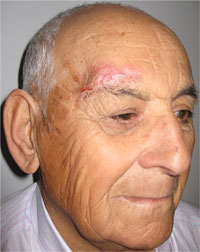 Quiste aracnoideo en silla turca