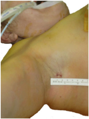 Single skin incision after the procedure 