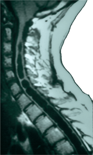 Sagittale MR beeld in syringomyelie