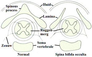 Spina bifida verborger