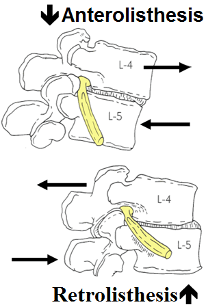 Root-Komprimierung in Spondylolisthesis
