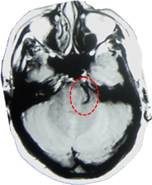 Imagen de RM de una arteria como causa de neuralgia del trigémino