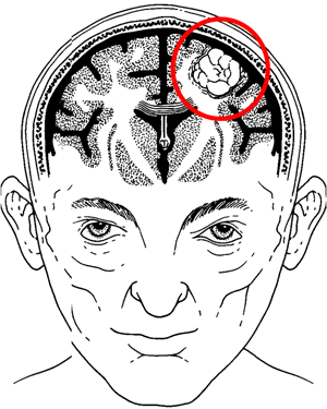 Hjärntumör biopsi