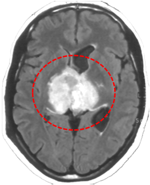 MR beeldvorming van thalamus tumor
