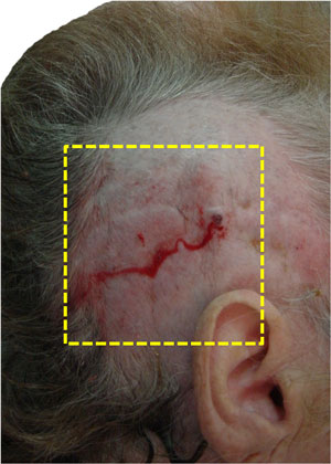 Ulceration and infection on the valve for the treatment of hydrocephalus