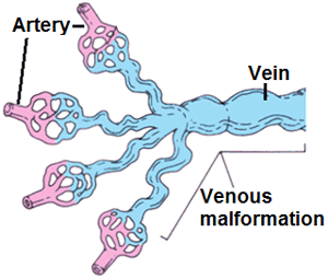 Brain venous malformation