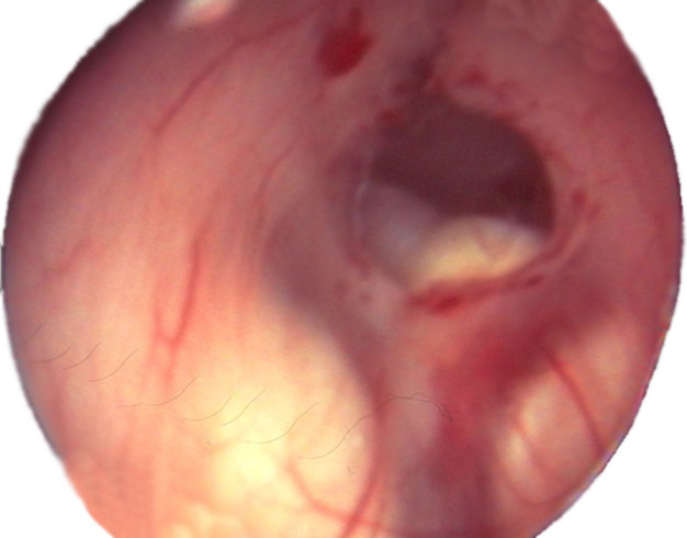 Visión endoscópica tras perforación del suelo del III ventrículo 
