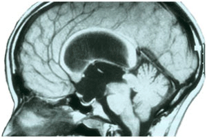 MRI in sagittal section of obstructive hydrocephalus secondary to pineal region tumor