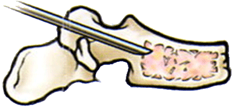 Collapsed bone tissue puncture during vertebroplasty