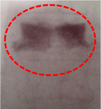 Imagen de Rx en proyección lateral de vertebroplastia