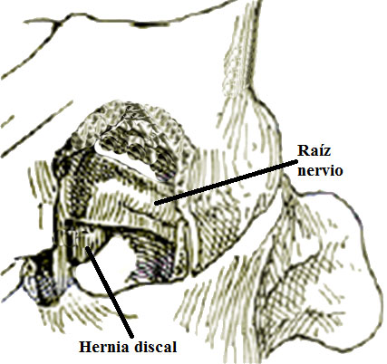 Extirpación vía posterior hernia discal cervical