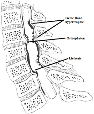 Zervikale Spondylose mit zervikaler Stenose